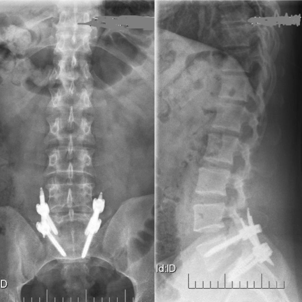 Percutaneous spinal fixation